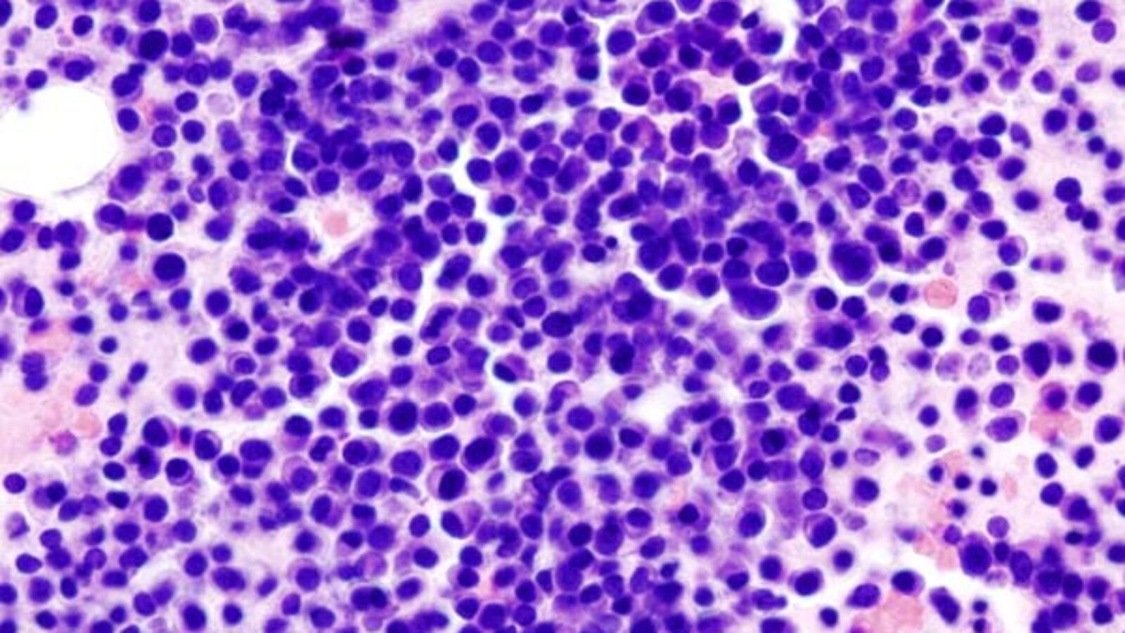 Histopathological image of multiple myoloma. Bone marrow aspirates. Hematoxylin & esoin stain